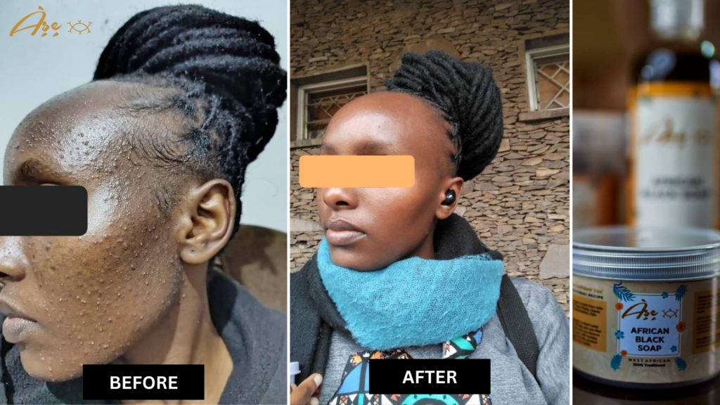Before and after skin result